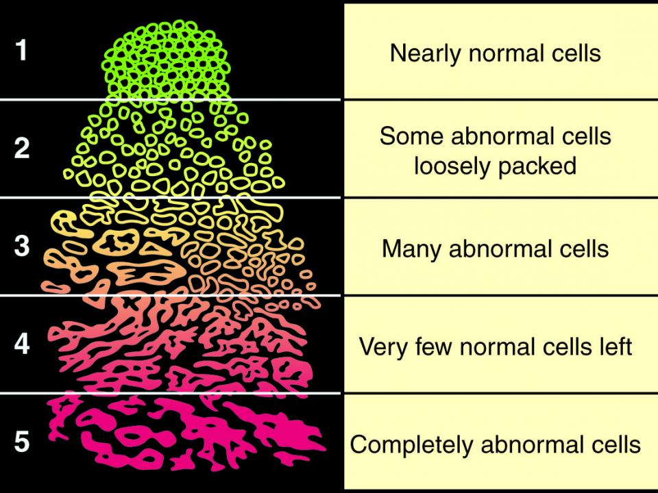 Staging And Grading Prostate Cancer | Irish Cancer Society